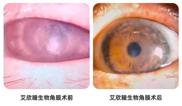 普瑞眼科生物角膜替代供体角膜的成功移植案例